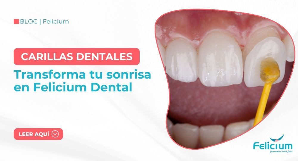 Carillas Dentales en Puno: Transforma tu sonrisa en Felicium Dental