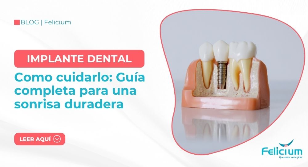 Cómo cuidar un implante dental: Guía completa para una sonrisa duradera