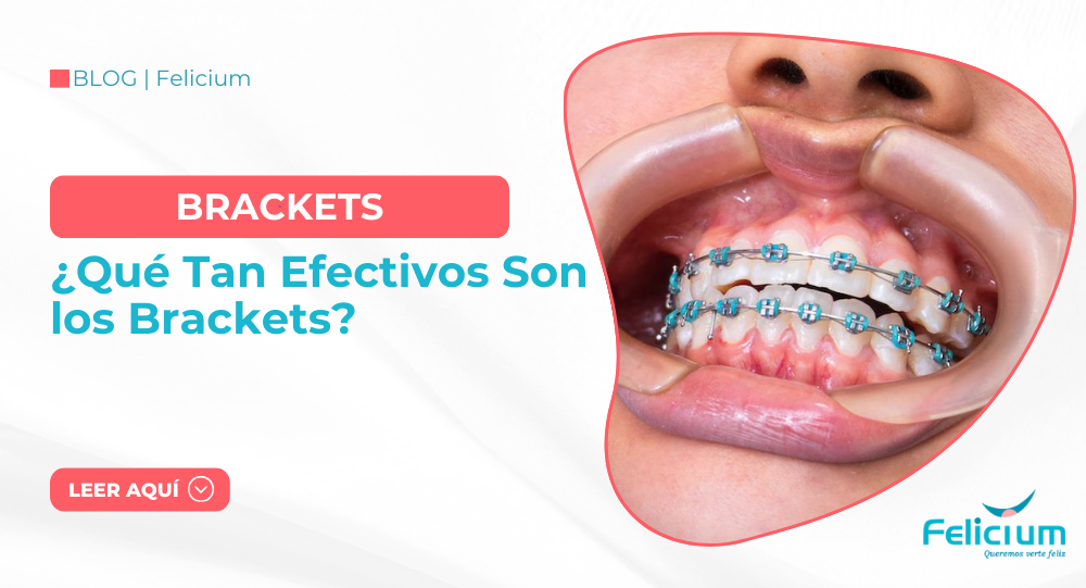 ¿Qué Tan Efectivos Son los Brackets? La Guía Completa de Felicium Dental