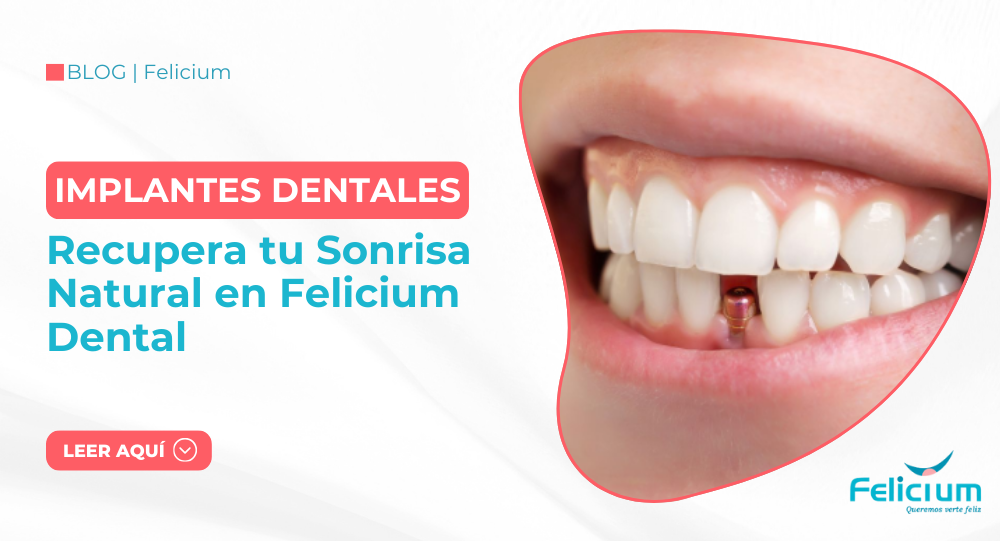 Implantes Dentales Estéticos: Recupera tu Sonrisa Natural en Felicium Dental